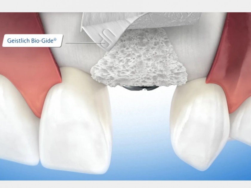 Bone Grafting Geistlich https://www.geistlich-pharma.com/dental/therapeutic-areas/minor-bone-augmentation